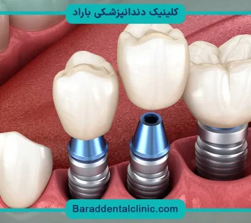 قیمت ایمپلنت دندان