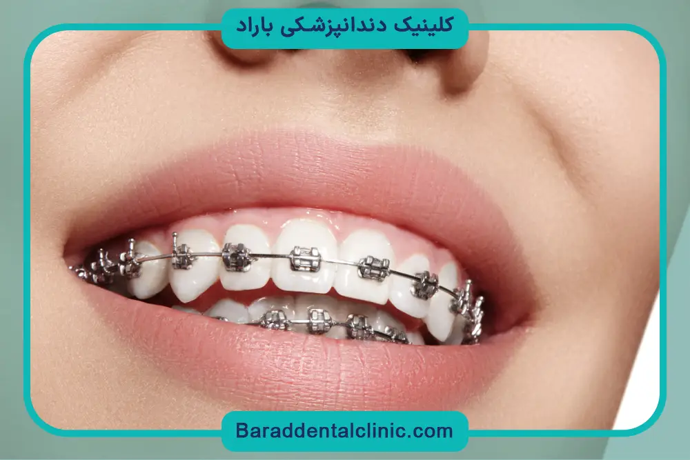 هزینه ارتودنسی در سال 1404