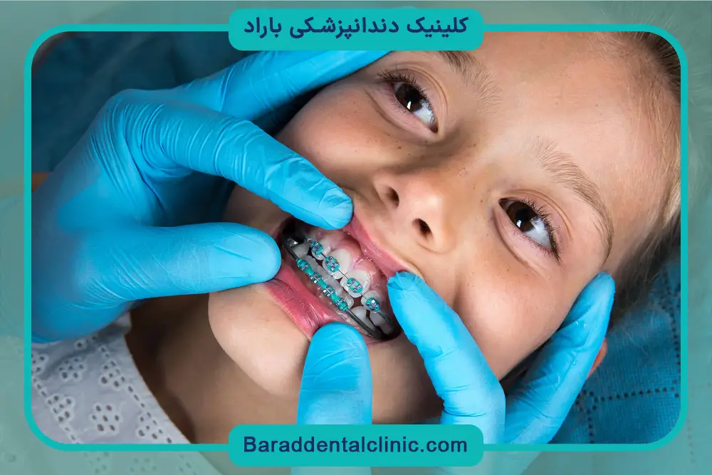 عوامل موثر بر هزینه درمان ارتودنسی 