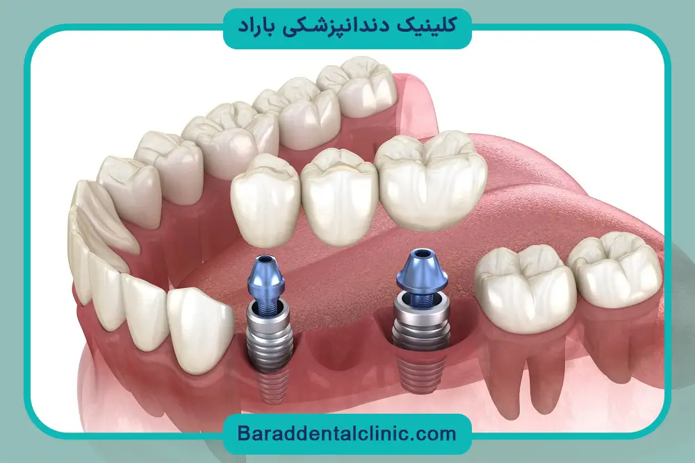 قیمت ایمپلنت دندان در سال 1404