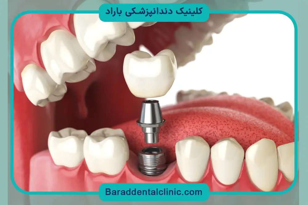 عوامل تاثیرگذار روی هزینه ایمپلنت دندان 