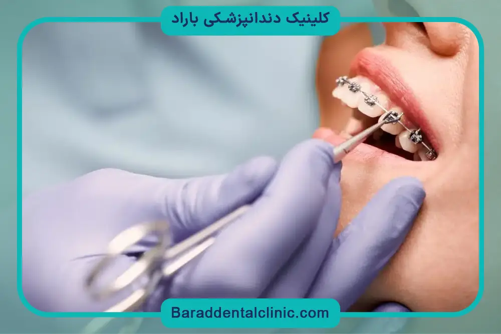 تاثیر روش ارتودنسی روی هزینه ارتودنسی 