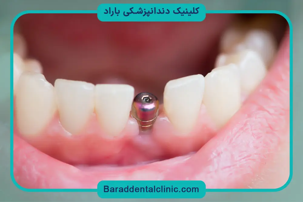 تاثیر تخصص جراح روی هزینه ایمپلنت دندان 