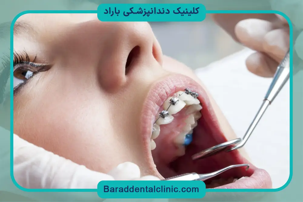 هزینه ارتودنسی بزرگسالان