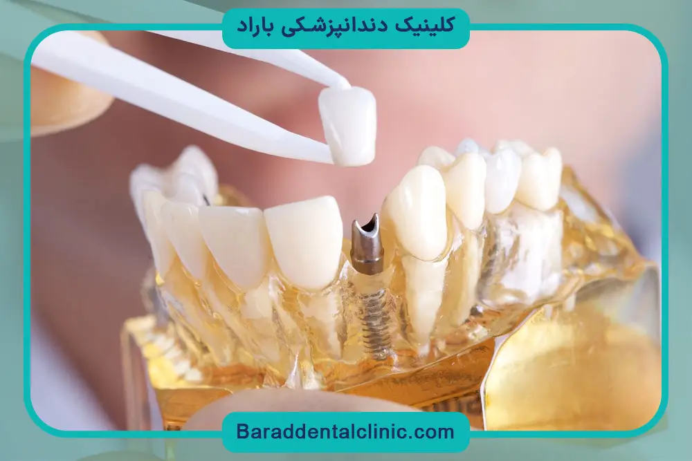 تفاوت قیمت ایمپلنت دندان داخلی و خارجی