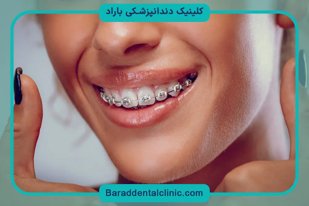 تاثیر تجهیزات مصرفی روی هزینه سیم کشی دندان 