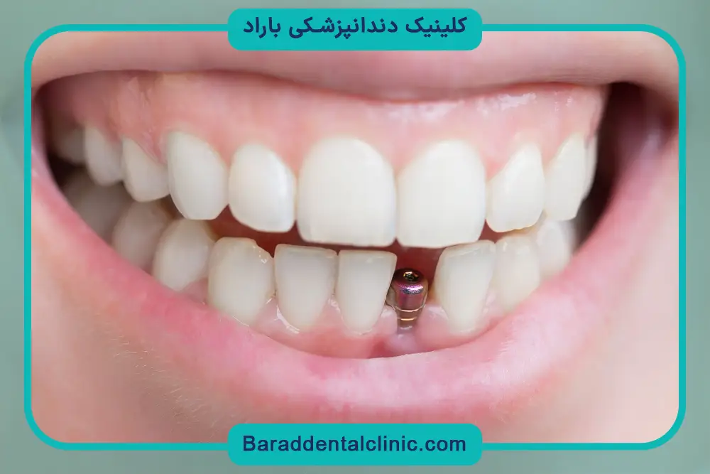 عوامل موثر بر هزینه ایمپلنت