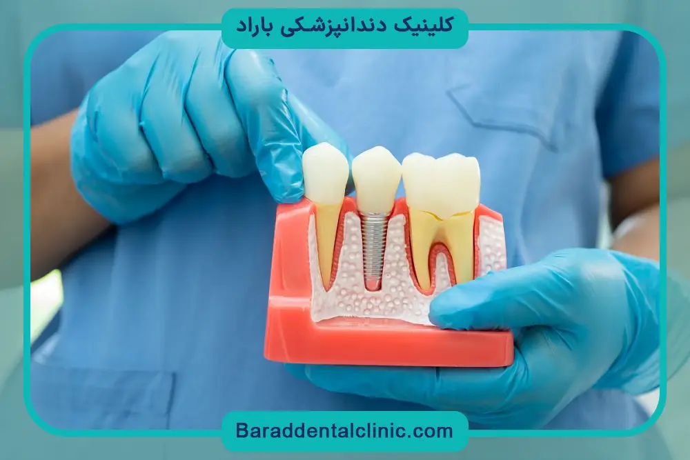 استفاده از برندهای اقتصادی برای کاهش هزینه درمان ایمپلنت دندان