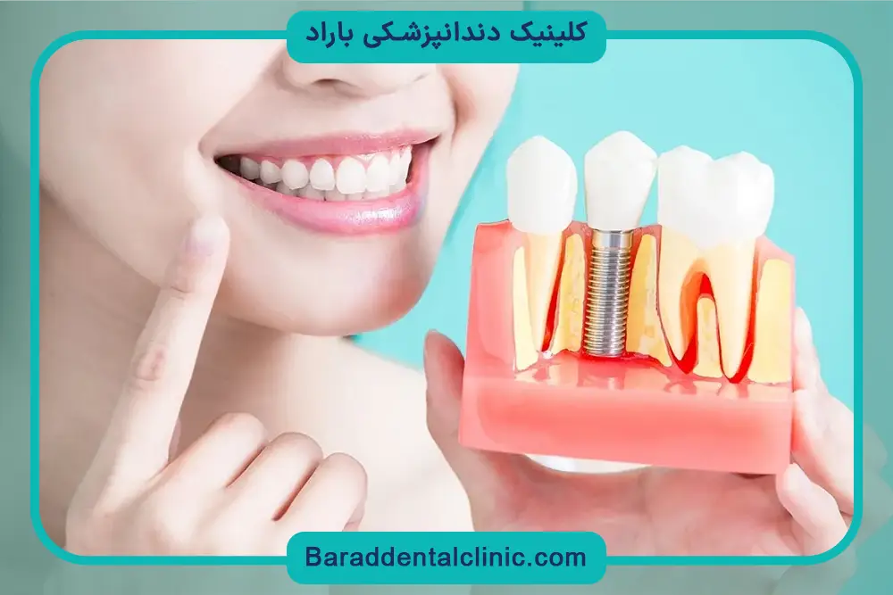 دلیل تفاوت هزینه کاشت ایمپلنت 