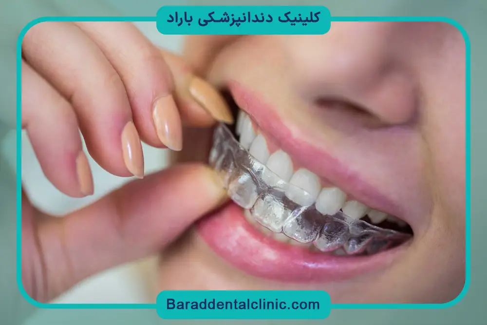 مقایسه قیمت ارتودنسی ثابت و متحرک 