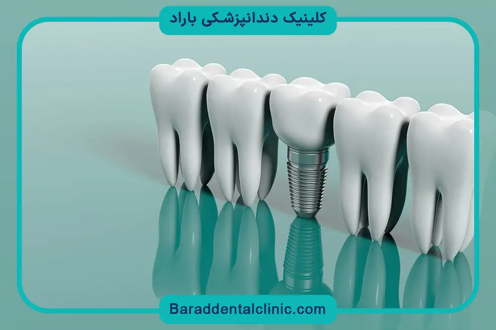 هزینه ایمپلنت همراه با جراحی لثه