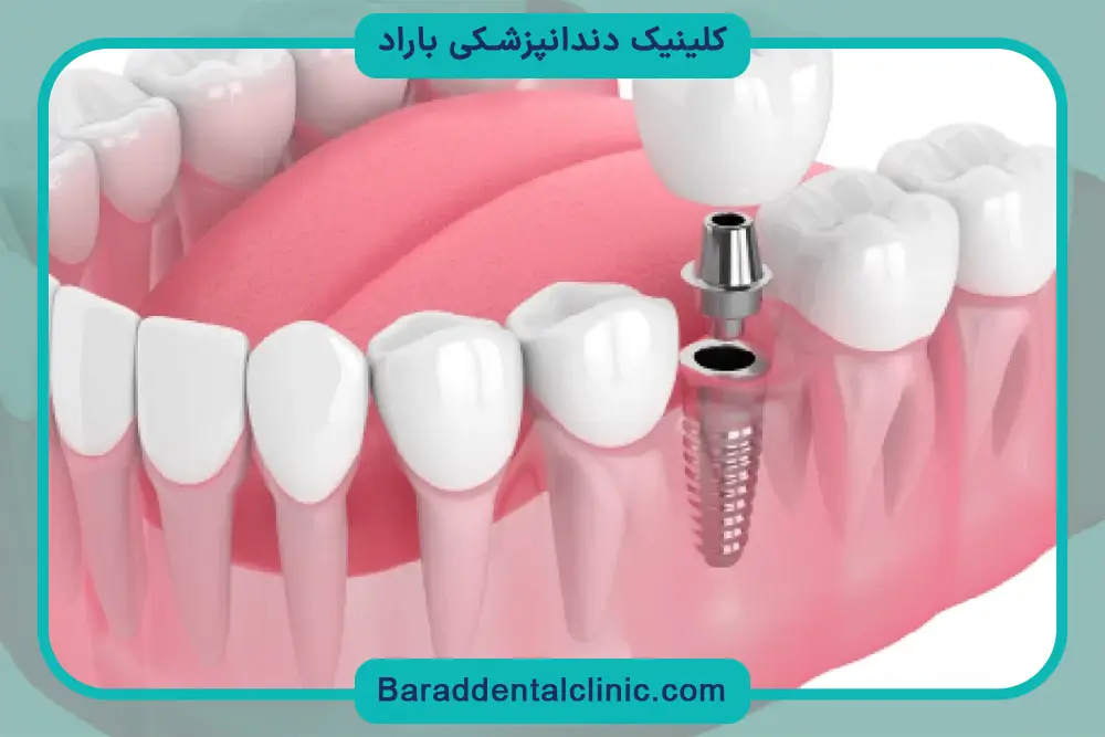 مقایسه هزینه درمان ایمپلنت دندان
