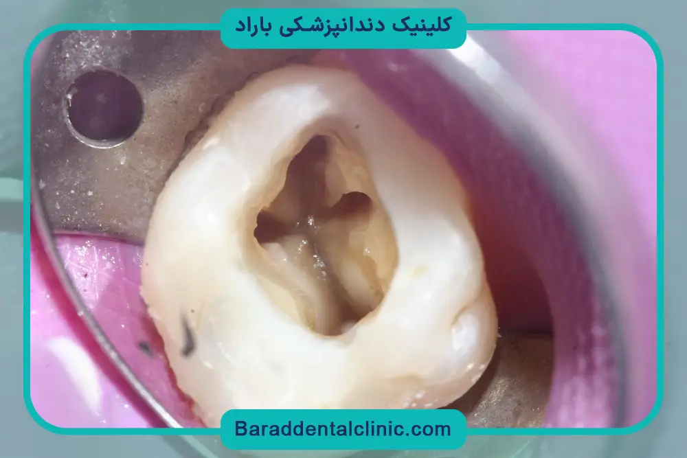 مزایای درمان ریشه