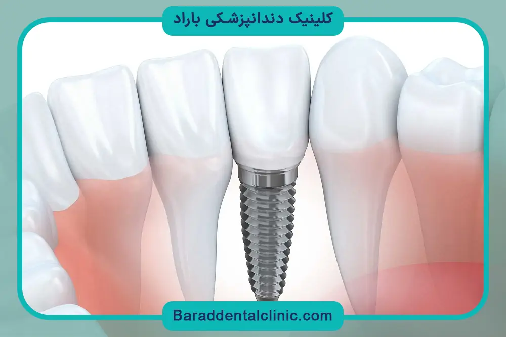 تاثیر تجربه جراح روی هزینه کاشت ایمپلنت 