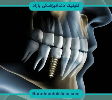 کاشت دندان تکی مصنوعی