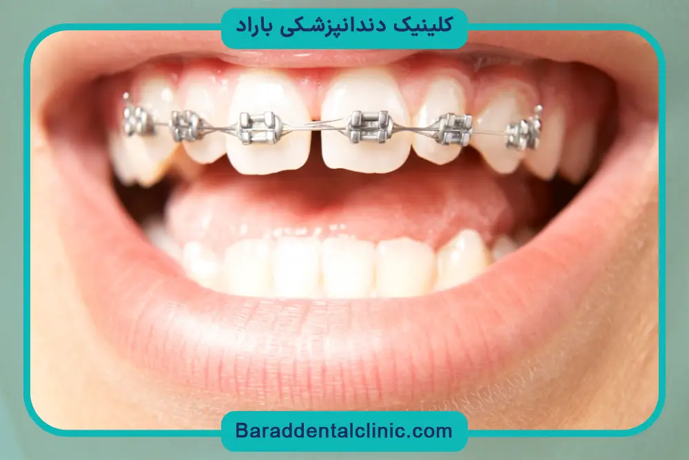 پرداخت هزینه سیم کشی دندان  با بیمه