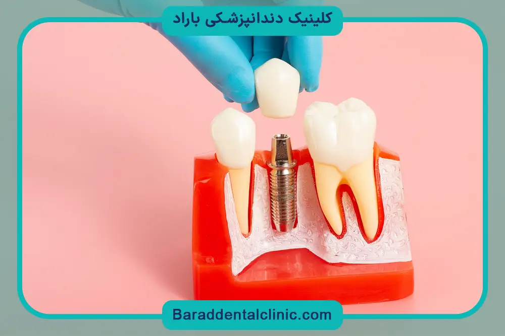 تاثیر دندانپزشک متخصص روی هزینه درمان ایمپلنت دندان