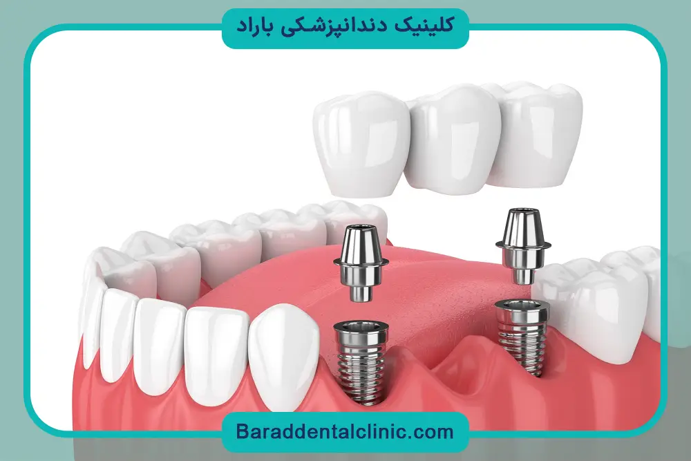 ایمپلنت دندان چیست؟