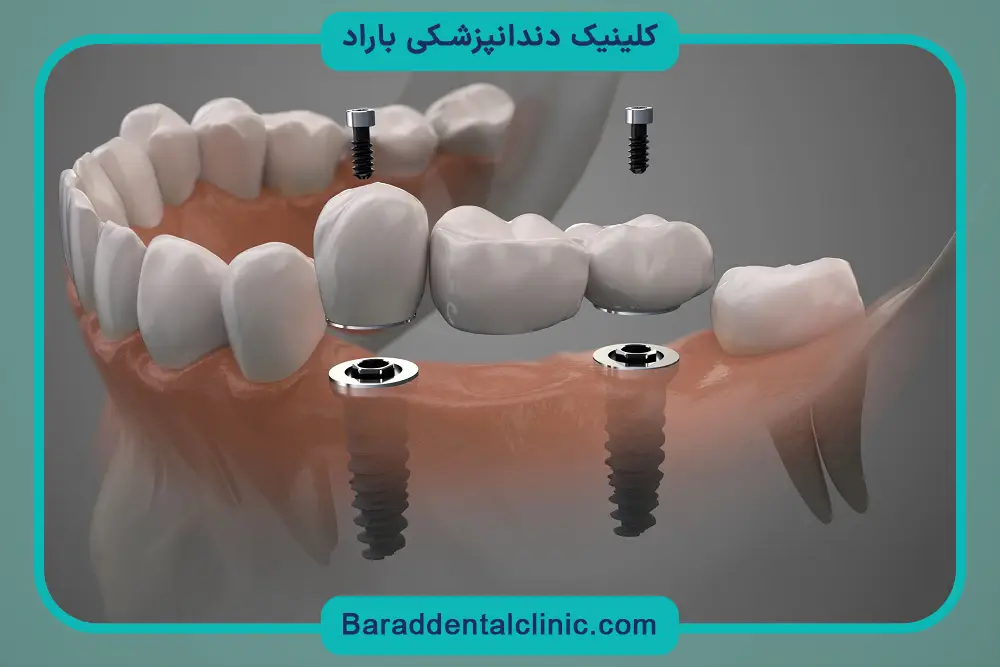 کاشت دندان پروتز ثابت