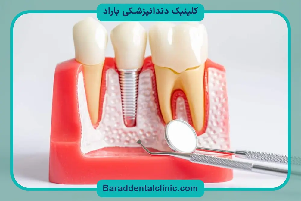 کاشت دندان بدون ایمپلنت با تکنولوژی جدید