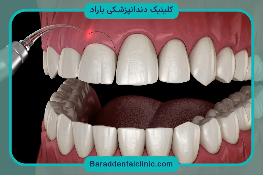کاشت دندان جلو بالا