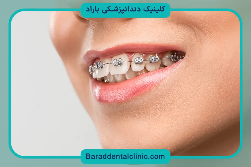 خدمات ارتودنسی نامرئی