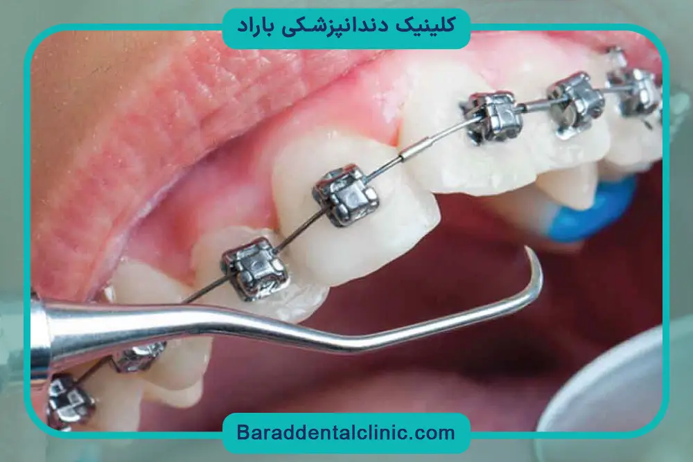 هزینه ارتودنسی با بیمه تامین اجتماعی