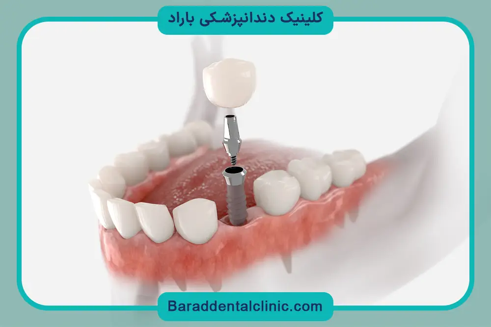 عوامل موثر بر موفقیت ایمپلنت دندان