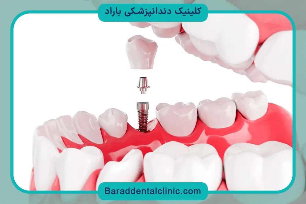 قیمت ایمپلنت کامل فک بالا و پایین