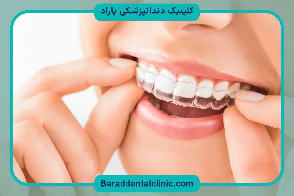 هزینه بلیچینگ دندان