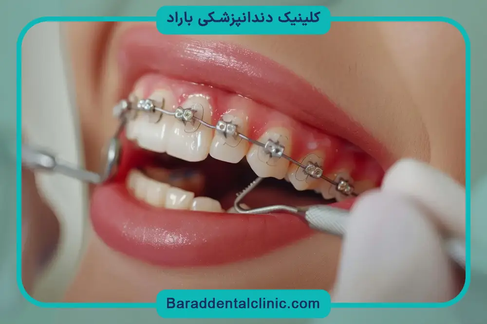 قیمت ارتودنسی دندان فک بالا