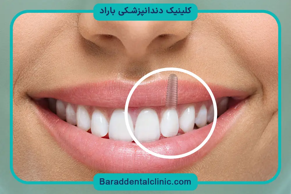 خطرات و عوارض ایمپلنت دندان