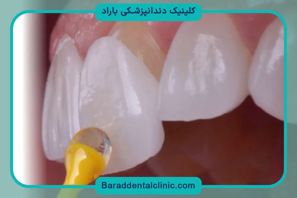 خدمات لمینت دندان چیست؟