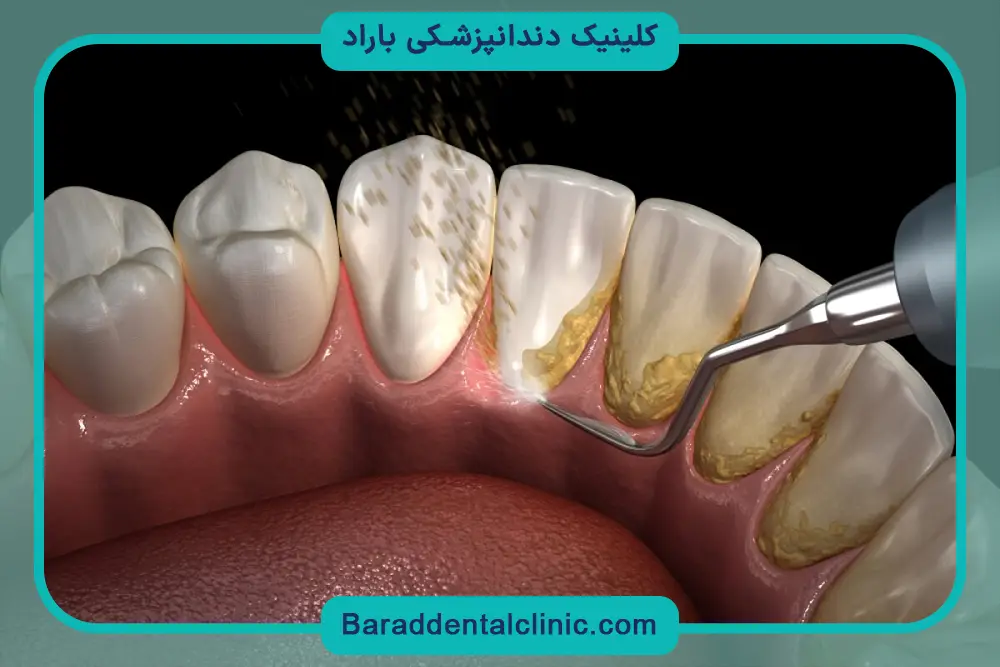 جرم گیری دندان چیست؟