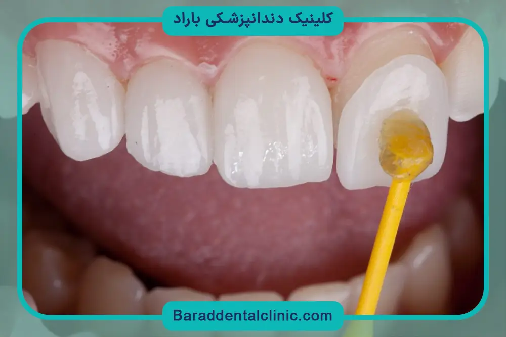 کاندیدای مناسب خدمات خدمات لمینت دندان 