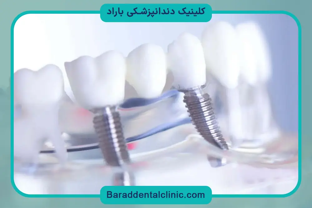 جدیدترین تکنولوژی کاشت دندان