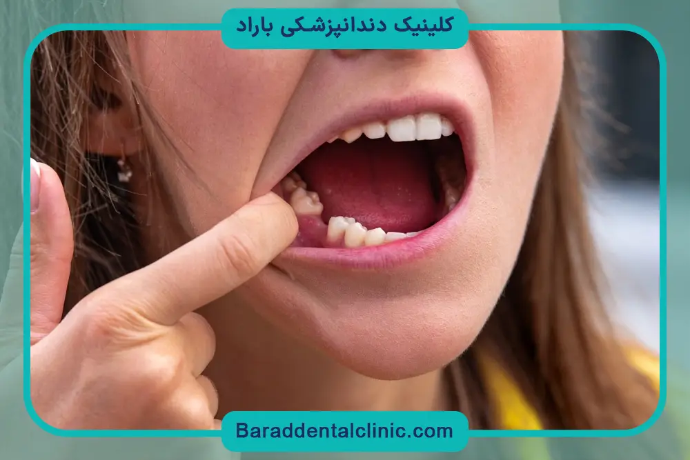 تاثیر برند ایمپلنت بر قیمت