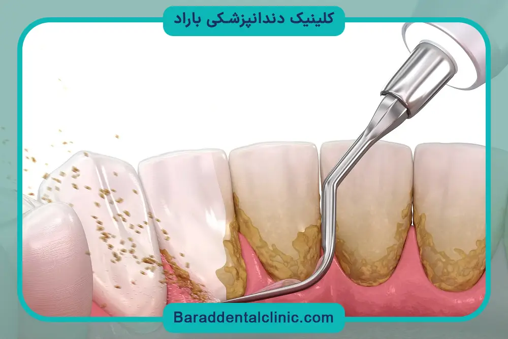 کاشت دندان پل ثابت
