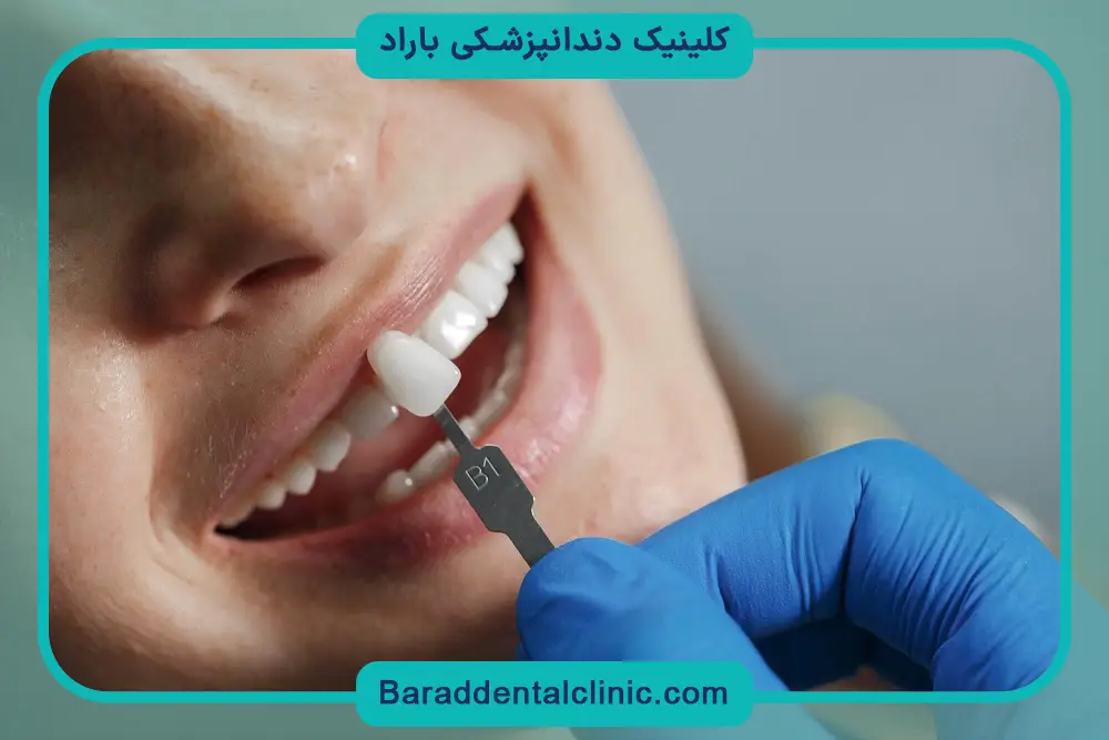 ماندگاری خدمات لمینت دندان 