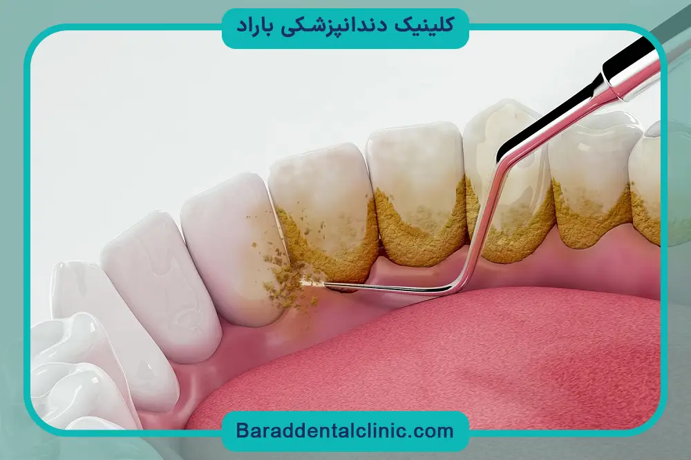 مراحل جرم گیری دندان 