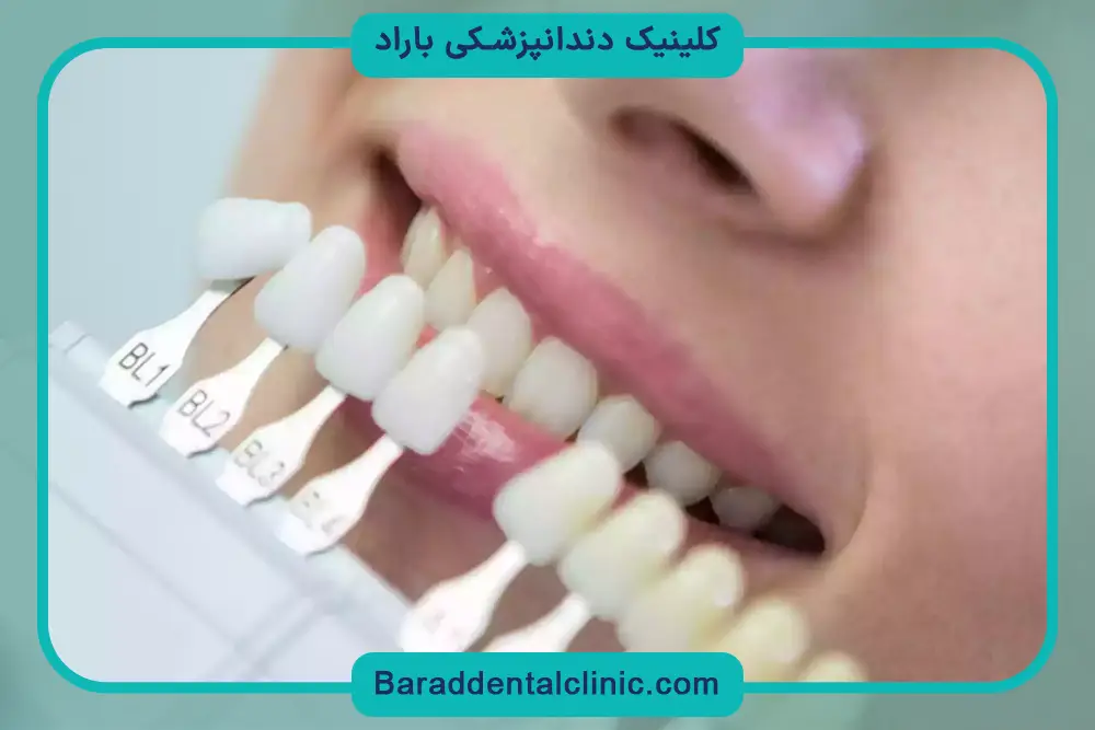 مراقبت‌های قبل و بعد خدمات لمینت دندان 