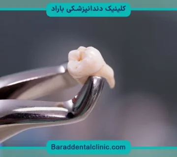 کاشت دندان بریج