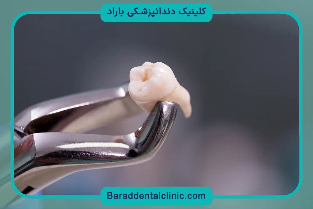 کاشت دندان بریج
