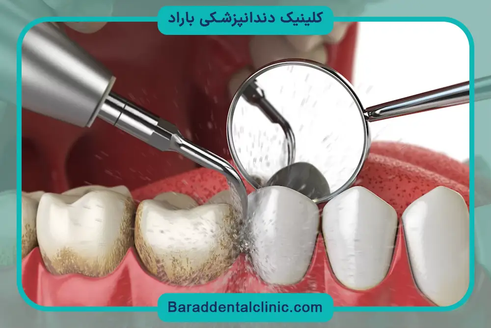 مراقبت‌های قبل و بعد جرم گیری دندان 