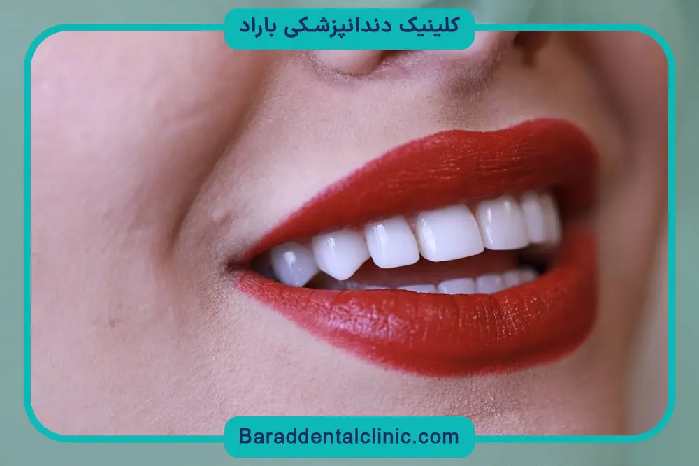 روش های مرتب سازی دندان