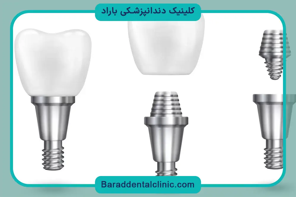 جدیدترین نوع کاشت دندان