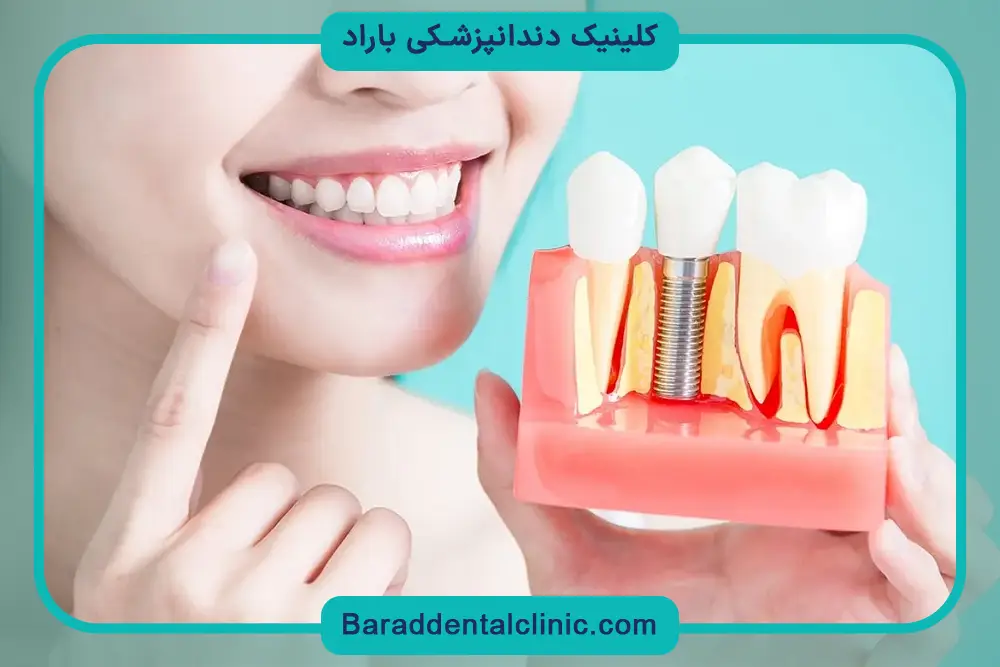 عکس ایمپلنت دندان قبل و بعد