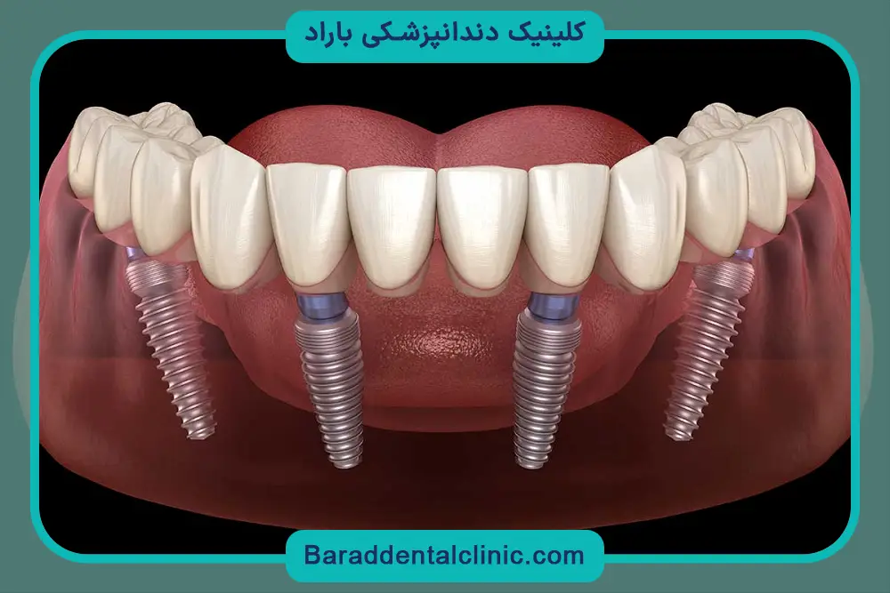 کاشت دندان چگونه است