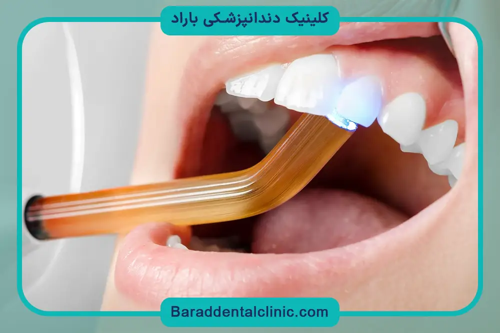 مراحل خدمات کامپوزیت دندان 