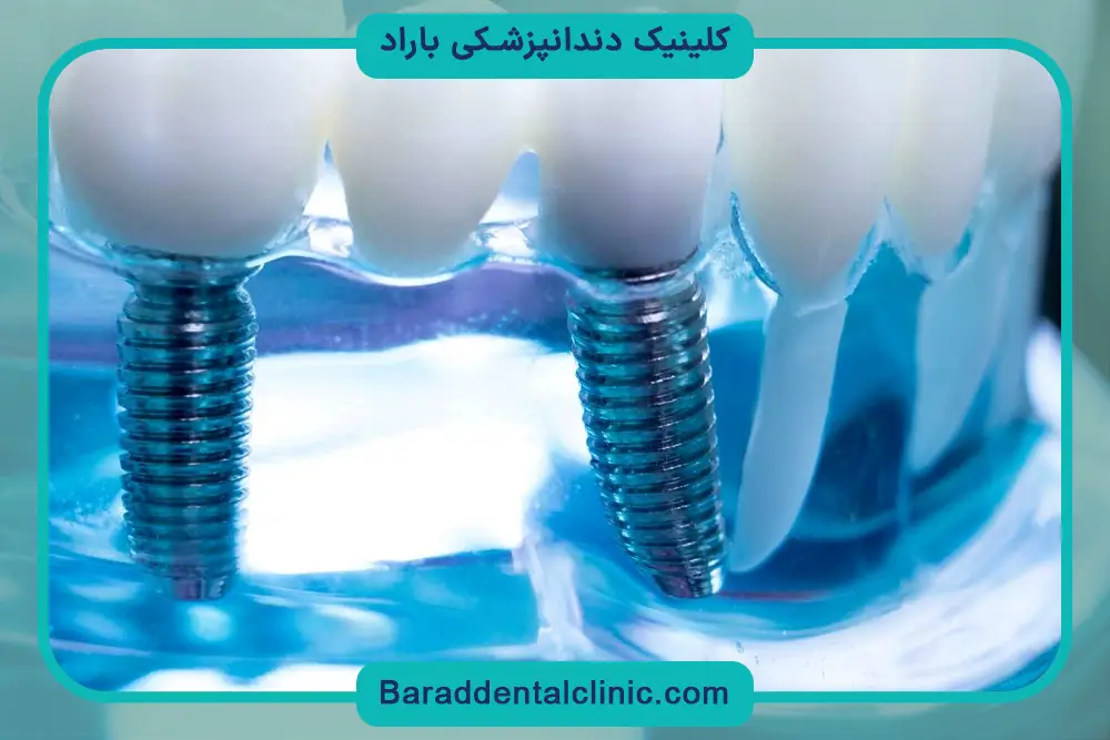 ایمپلنت پیچی بهتر است یا چسبی؟ انتخاب بهترین گزینه